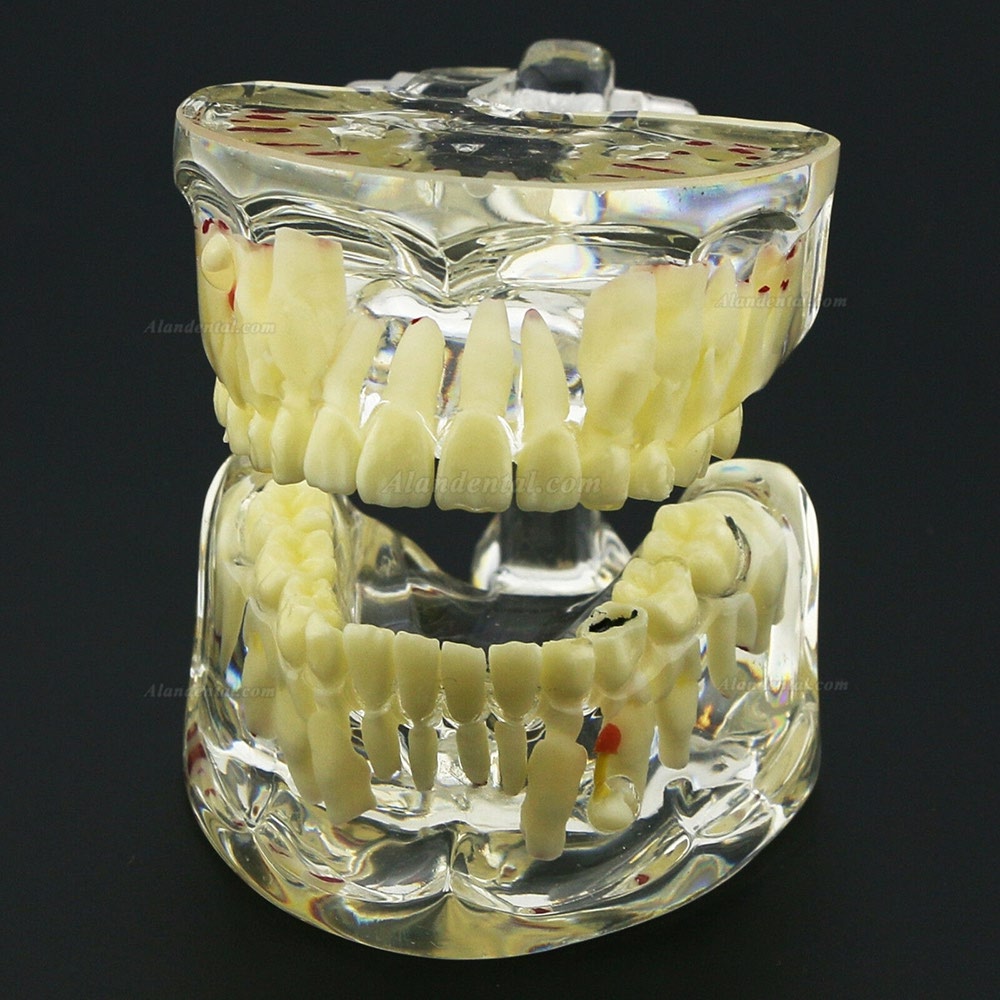 Dental Children Teeth Model Pediatric Pathology Demonstration Study Model 4002