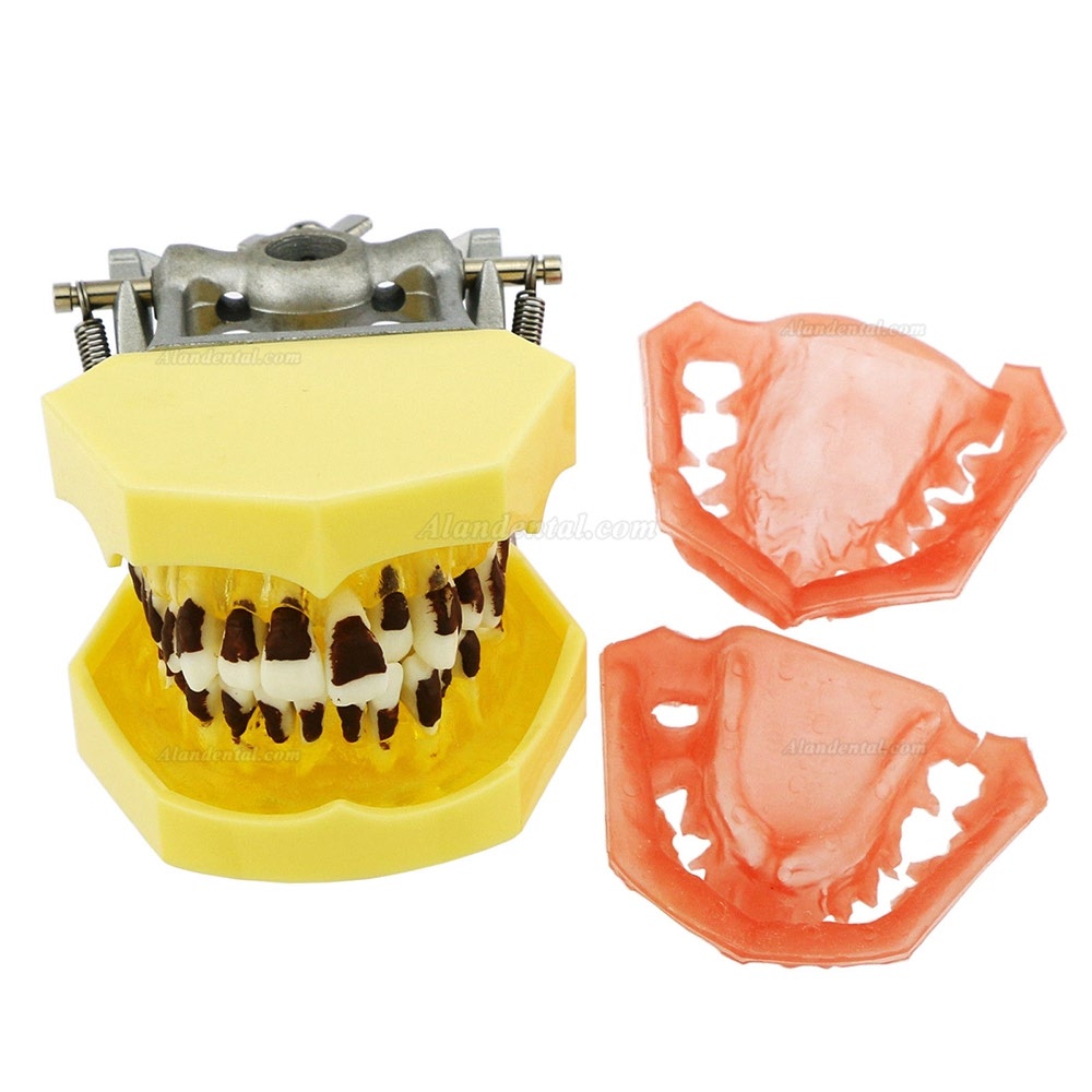 Dental Periodontosis Disease Teeth Model Demonstrates Inflamed Gingivae Calculs 4003