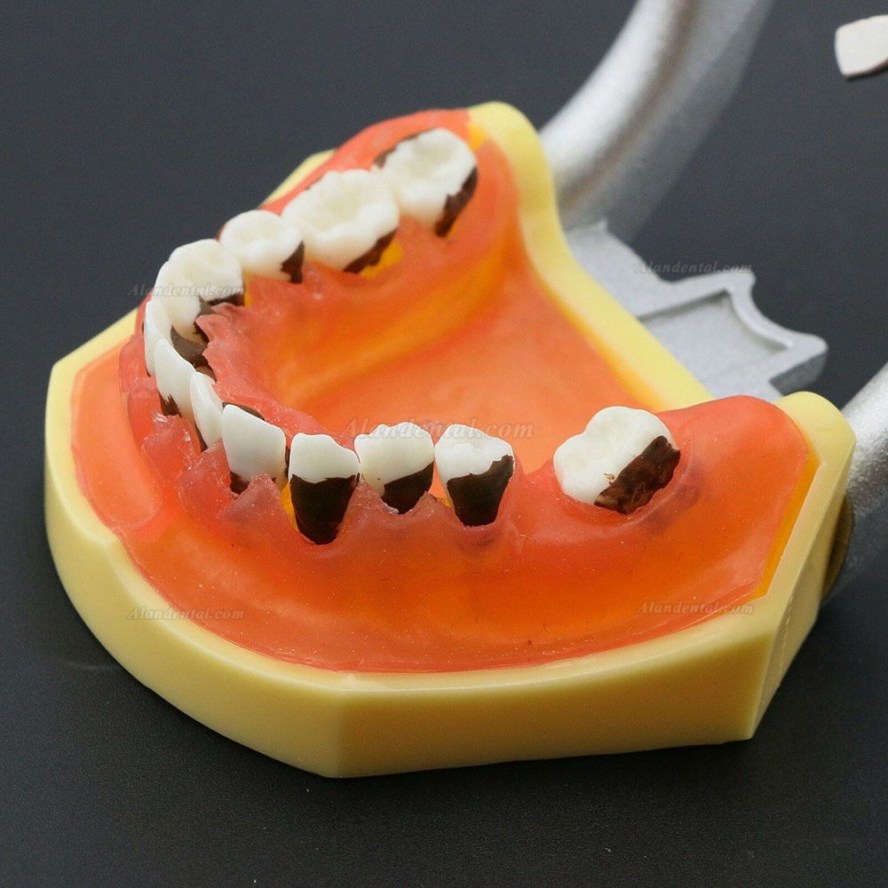 Dental Periodontosis Disease Teeth Model Demonstrates Inflamed Gingivae Calculs 4003