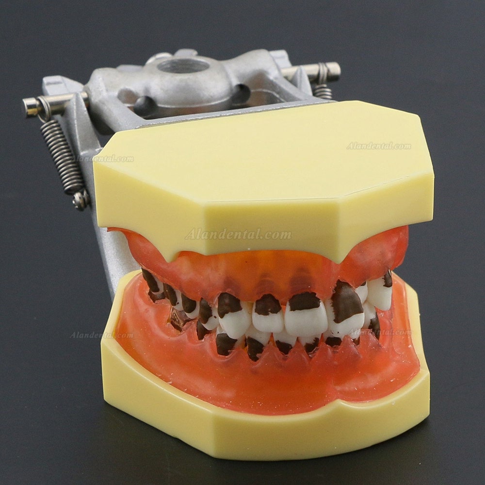 Dental Periodontosis Disease Teeth Model Demonstrates Inflamed Gingivae Calculs 4003