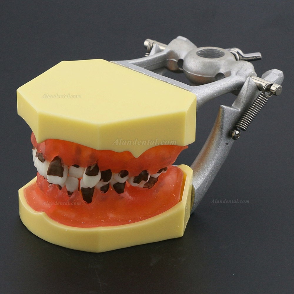 Dental Periodontosis Disease Teeth Model Demonstrates Inflamed Gingivae Calculs 4003
