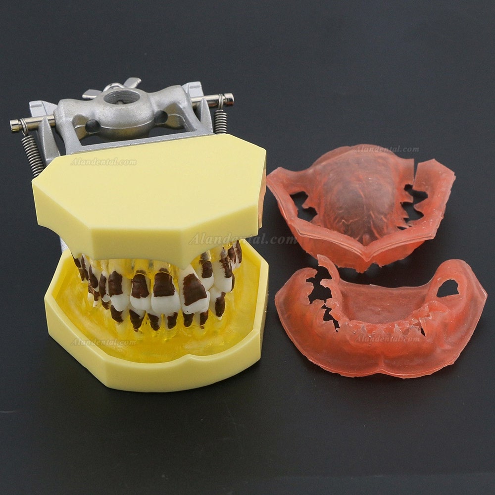 Dental Periodontosis Disease Teeth Model Demonstrates Inflamed Gingivae Calculs 4003