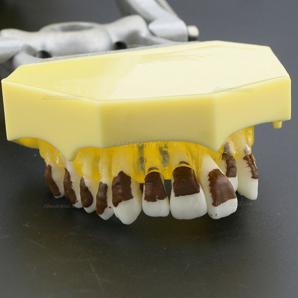 Dental Periodontosis Disease Teeth Model Demonstrates Inflamed Gingivae Calculs 4003