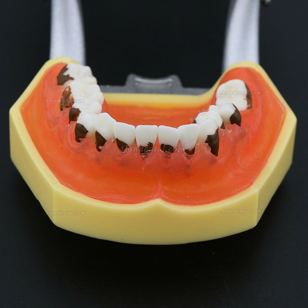 Dental Periodontosis Disease Teeth Model Demonstrates Inflamed Gingivae Calculs 4003