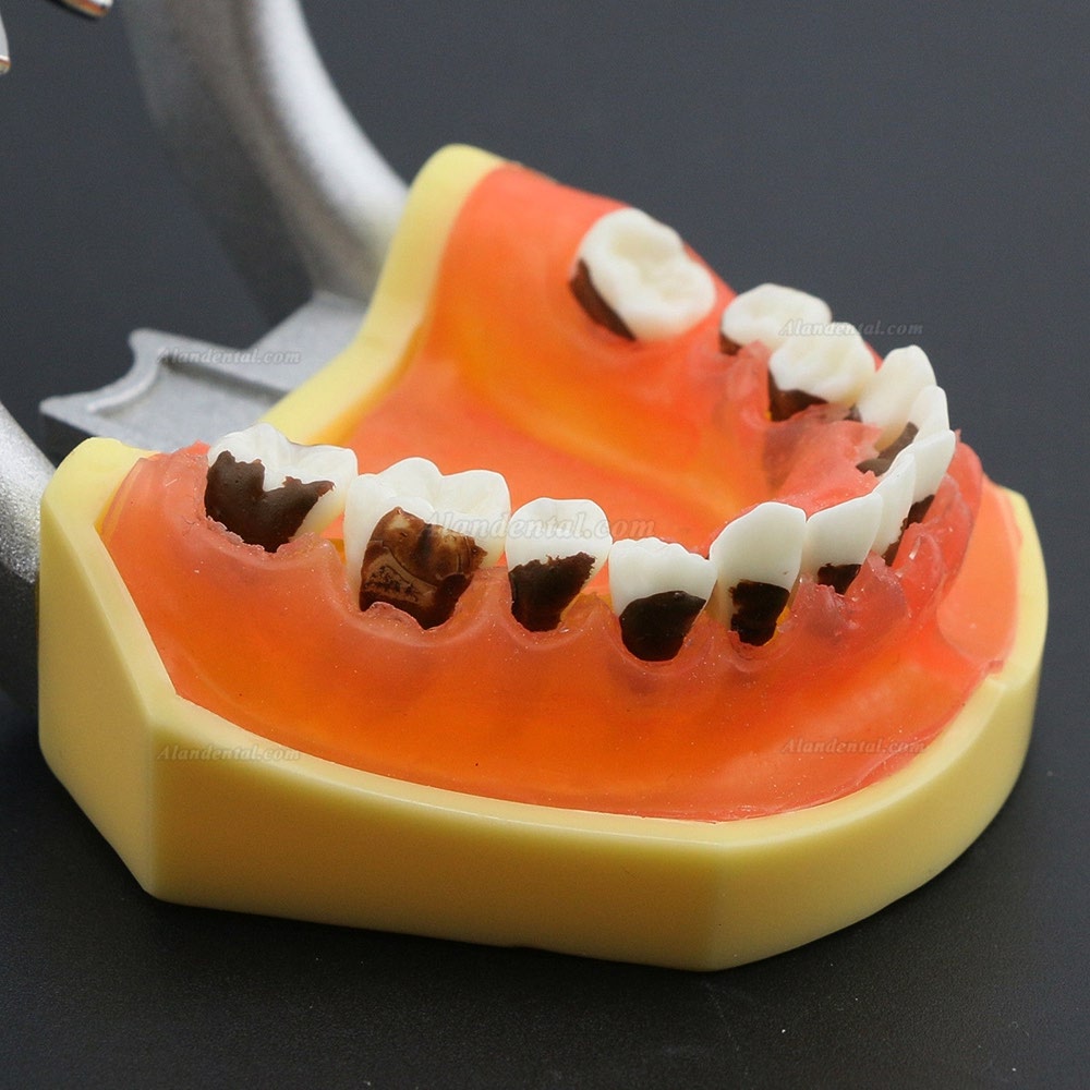 Dental Periodontosis Disease Teeth Model Demonstrates Inflamed Gingivae Calculs 4003