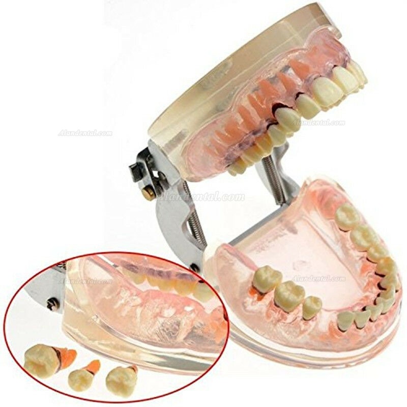 Dental Model Adult Pathological Periodontal Disease Study Teeth Model 4017