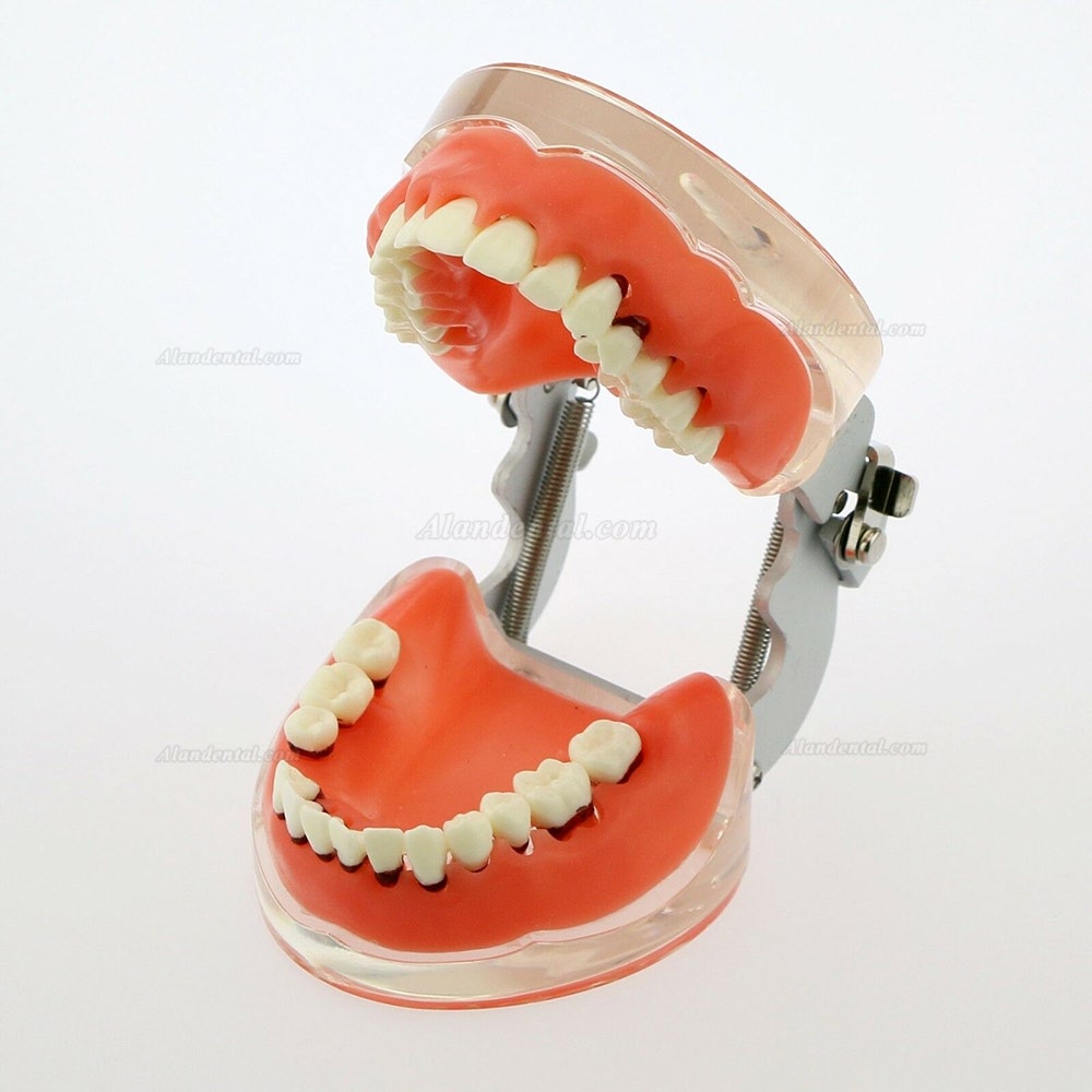 Dental Model Adult Pathological Periodontal Disease Study Teeth Model 4017