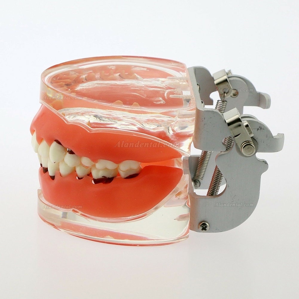 Dental Model Adult Pathological Periodontal Disease Study Teeth Model 4017