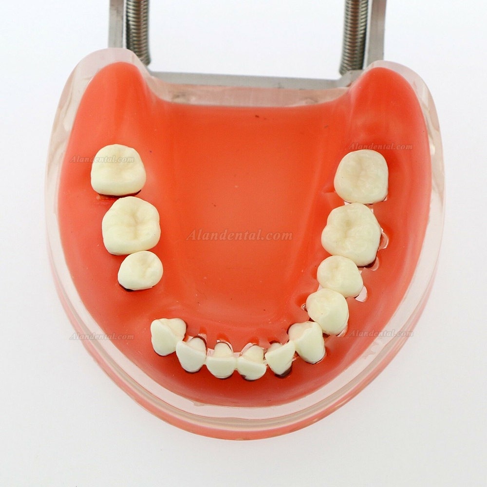 Dental Model Adult Pathological Periodontal Disease Study Teeth Model 4017