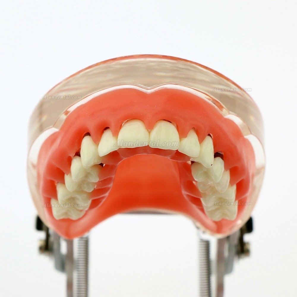 Dental Model Adult Pathological Periodontal Disease Study Teeth Model 4017