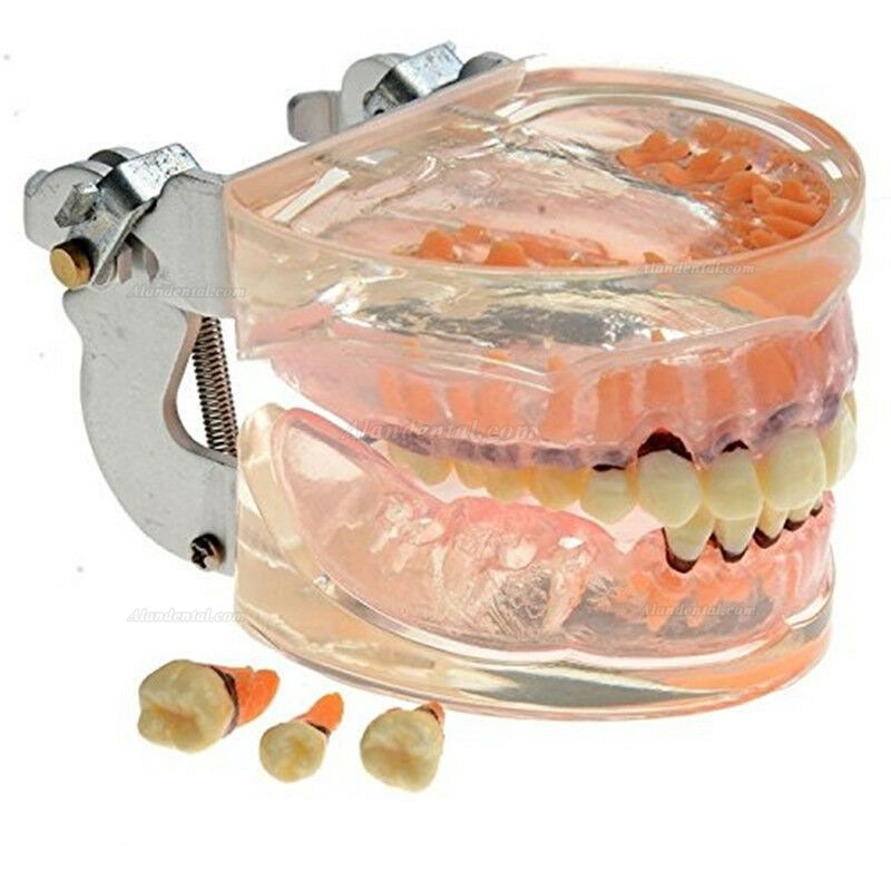 Dental Model Adult Pathological Periodontal Disease Study Teeth Model 4017