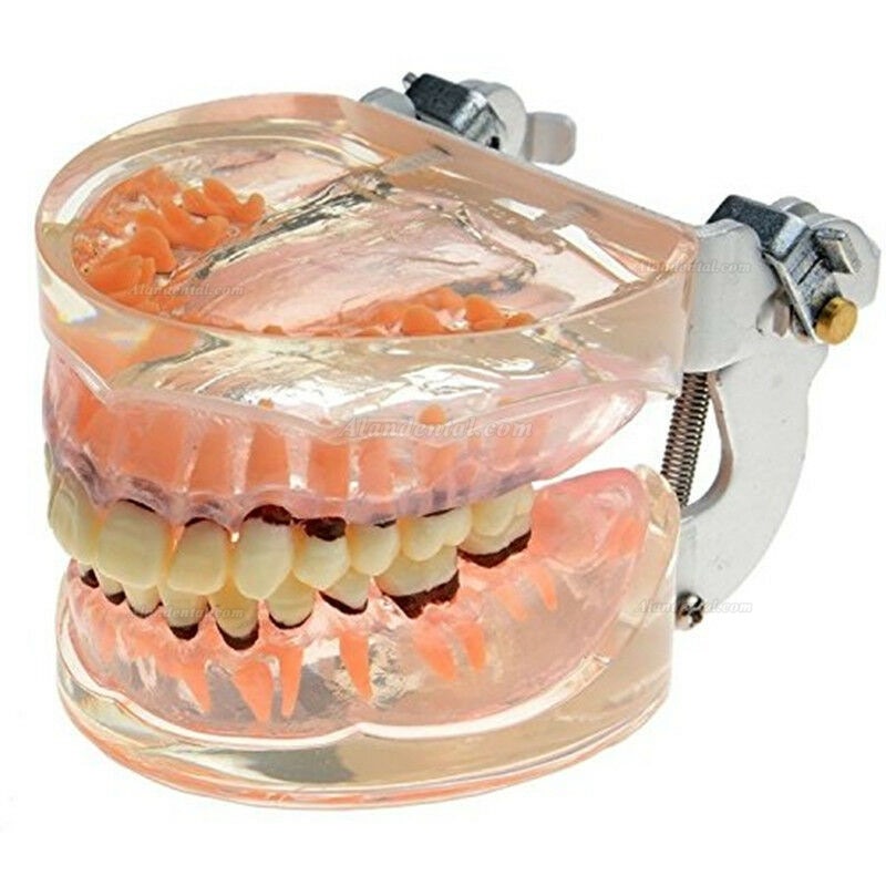 Dental Model Adult Pathological Periodontal Disease Study Teeth Model 4017