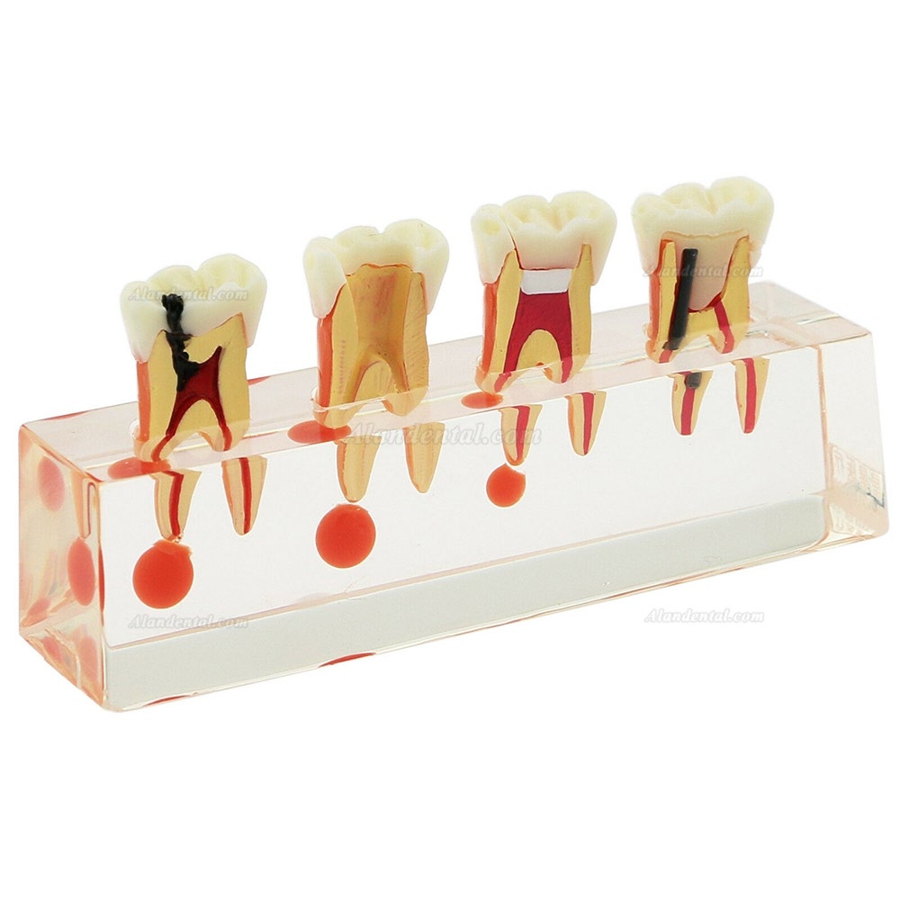 Dental Teeth Study Model 4-Stage Endodontic Treatment Model 4018 01