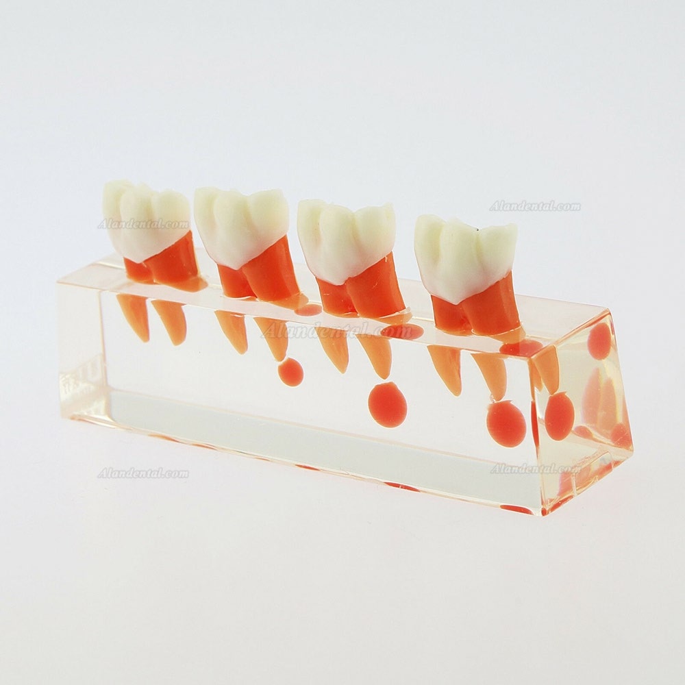 Dental Teeth Study Model 4-Stage Endodontic Treatment Model 4018 01