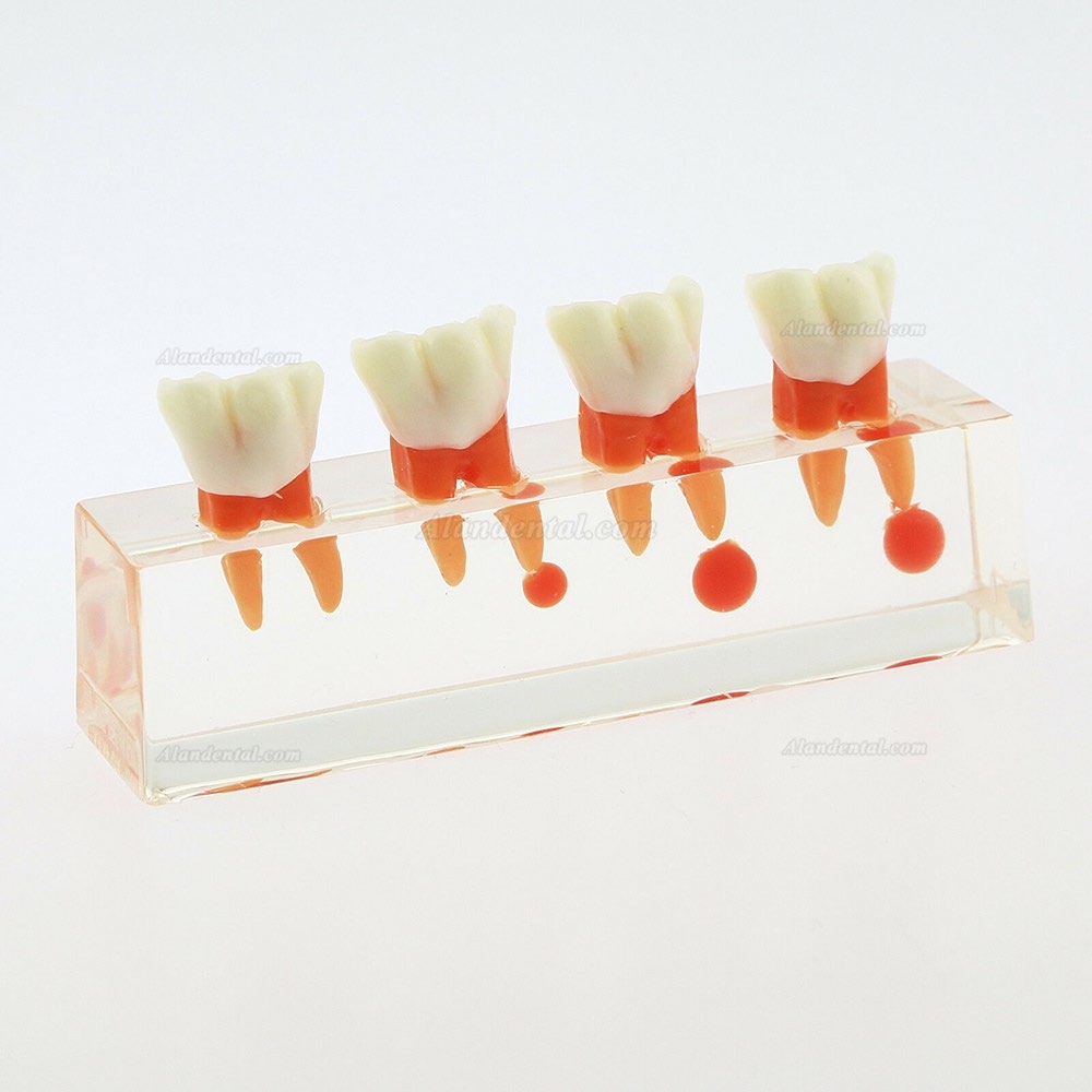 Dental Teeth Study Model 4-Stage Endodontic Treatment Model 4018 01