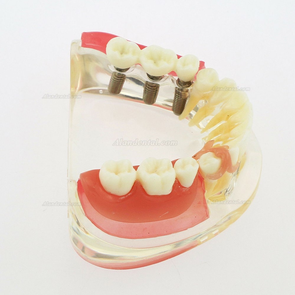 Dental Inferior Teeth Model Restoration Implant Removable Bridge Demo Model 6006