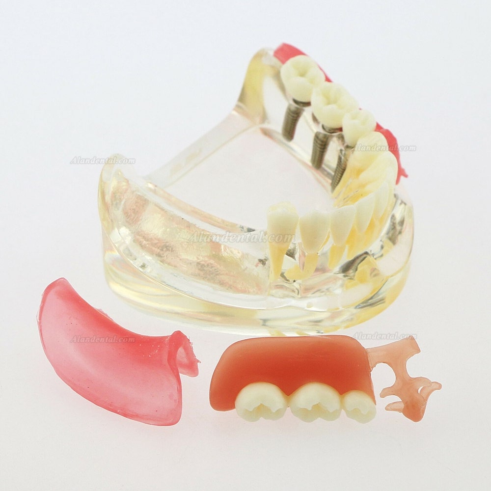 Dental Inferior Teeth Model Restoration Implant Removable Bridge Demo Model 6006