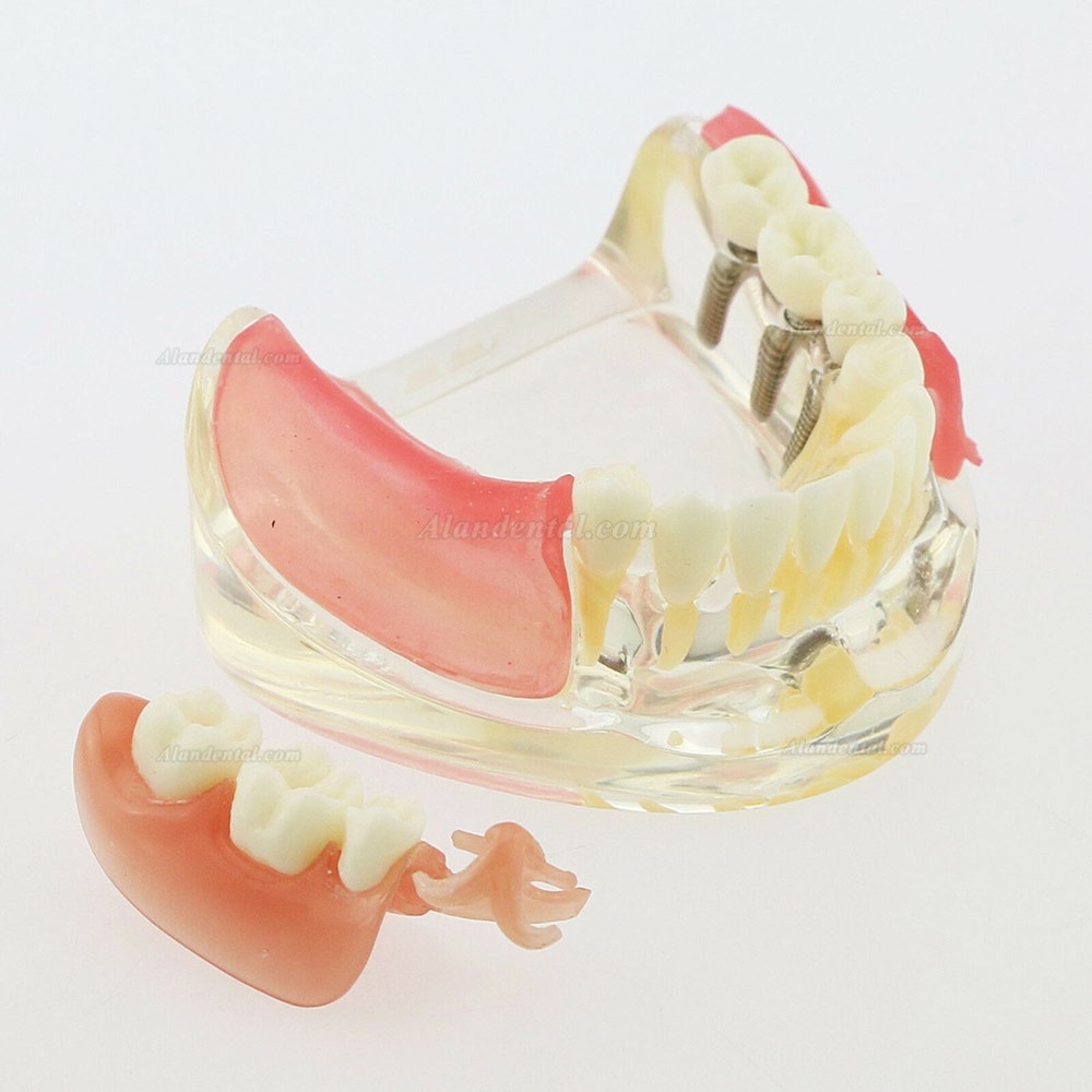 Dental Inferior Teeth Model Restoration Implant Removable Bridge Demo Model 6006