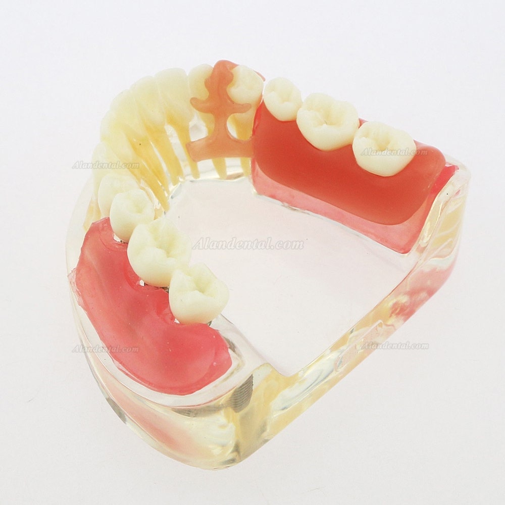 Dental Inferior Teeth Model Restoration Implant Removable Bridge Demo Model 6006