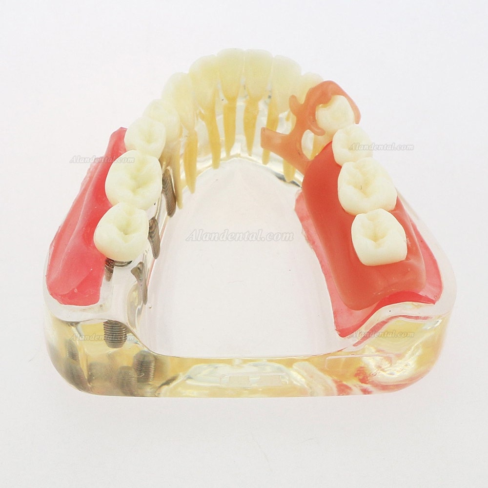 Dental Inferior Teeth Model Restoration Implant Removable Bridge Demo Model 6006