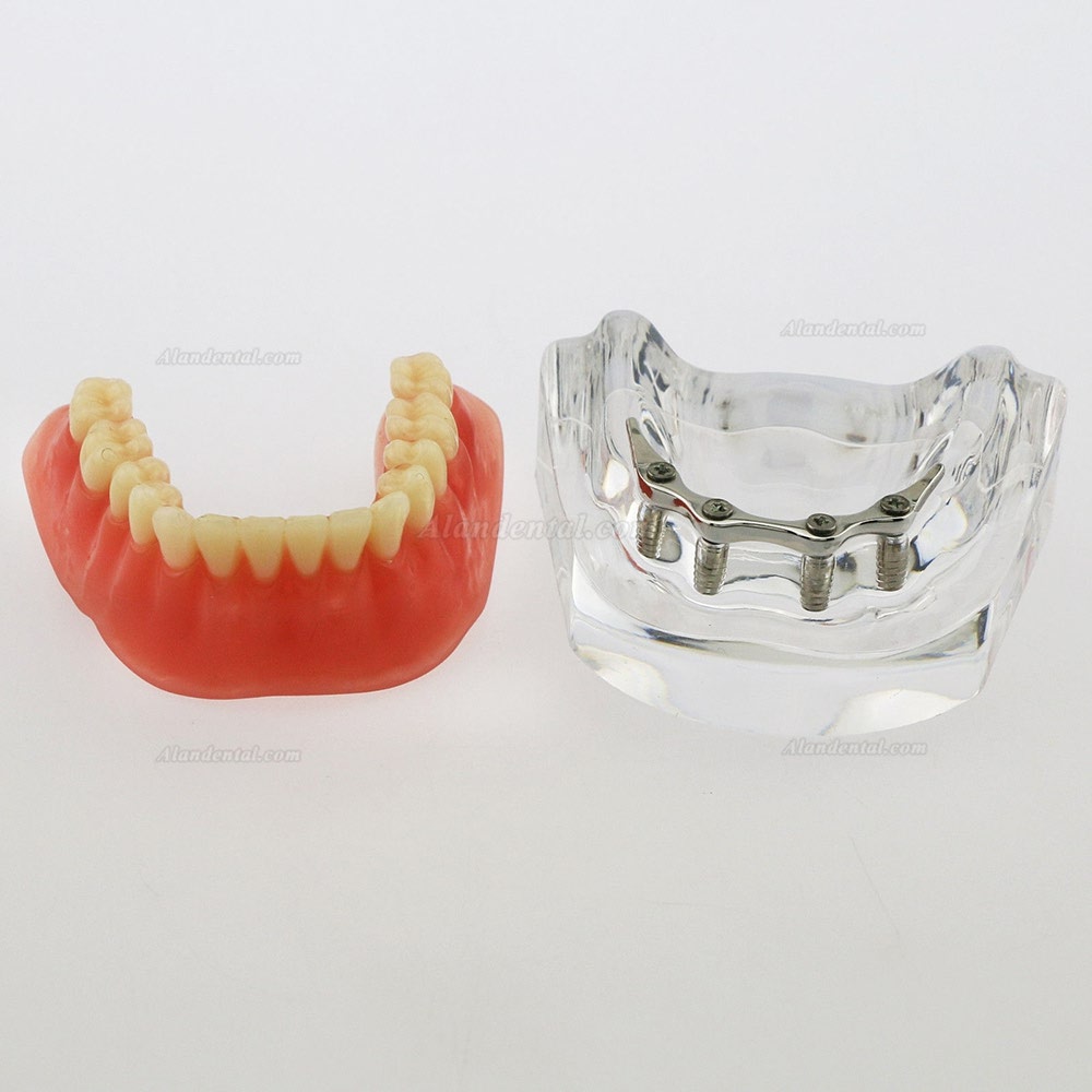 Dental Inferior Teeth Model Overdenture Precision 4 Implants Demo Silver Bar