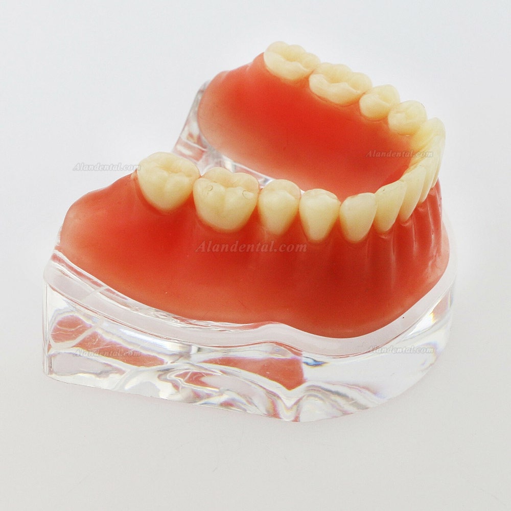 Dental Inferior Teeth Model Overdenture Precision 4 Implants Demo Silver Bar
