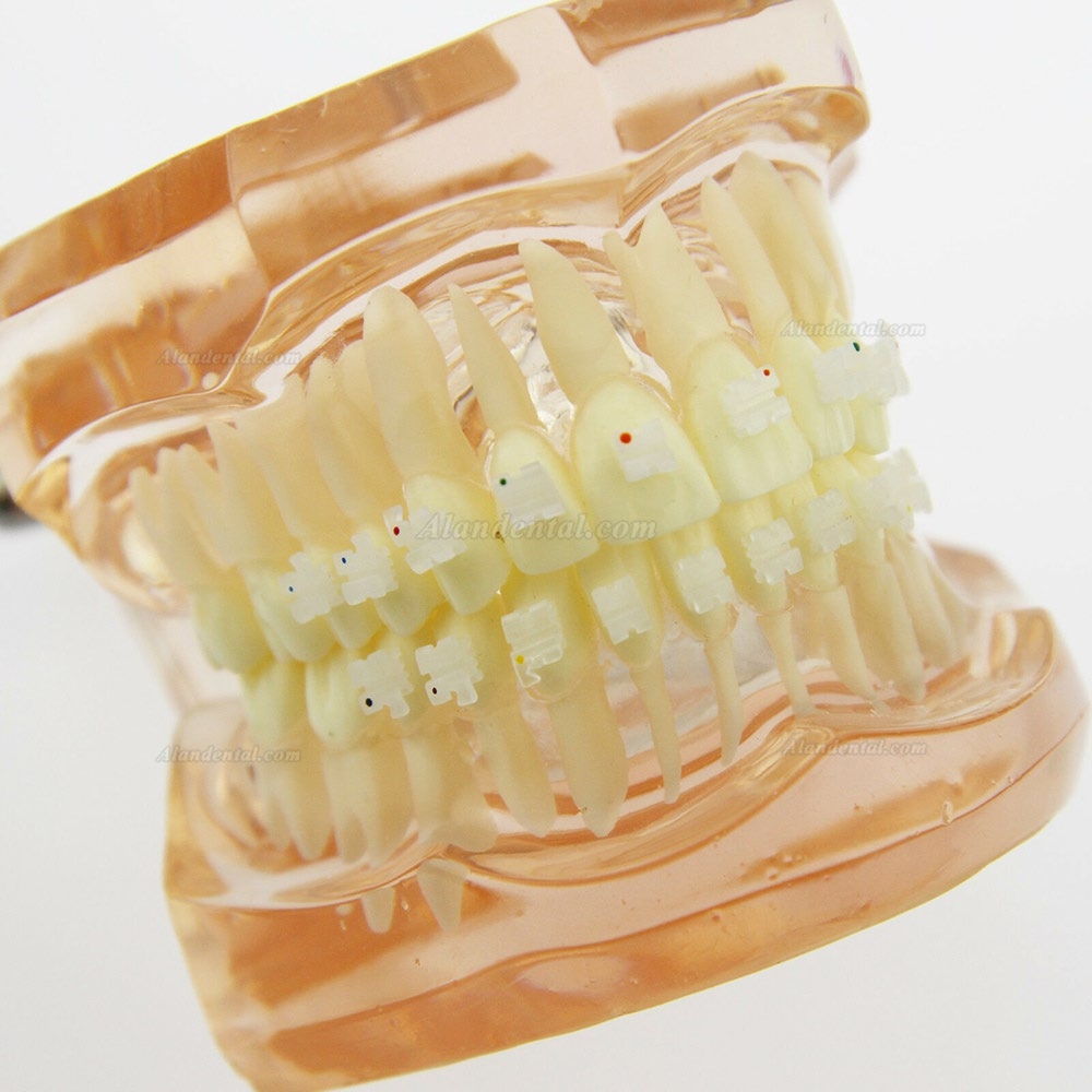 Dental Orthodontics Treatment Model Demo Teeth Ceramic/Metal Brackets