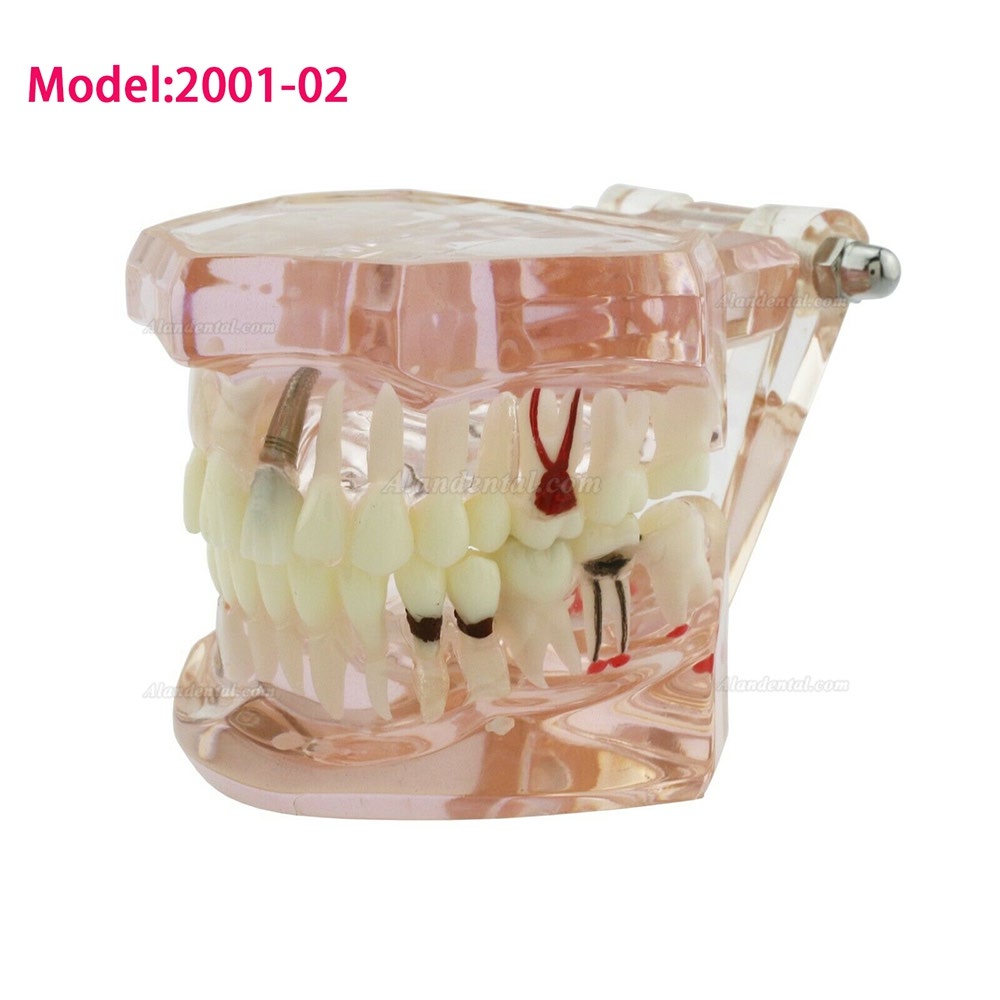 Dental Teeth Disease Model Implant Demo Caries Periodontium Transparent Pink