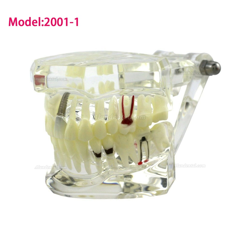 Dental Teeth Disease Model Implant Demo Caries Periodontium Transparent Pink