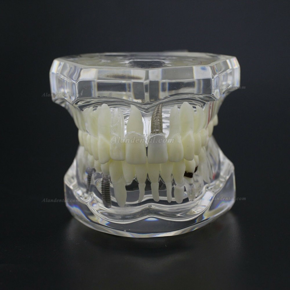 Dental Teeth Disease Model Implant Demo Caries Periodontium Transparent Pink