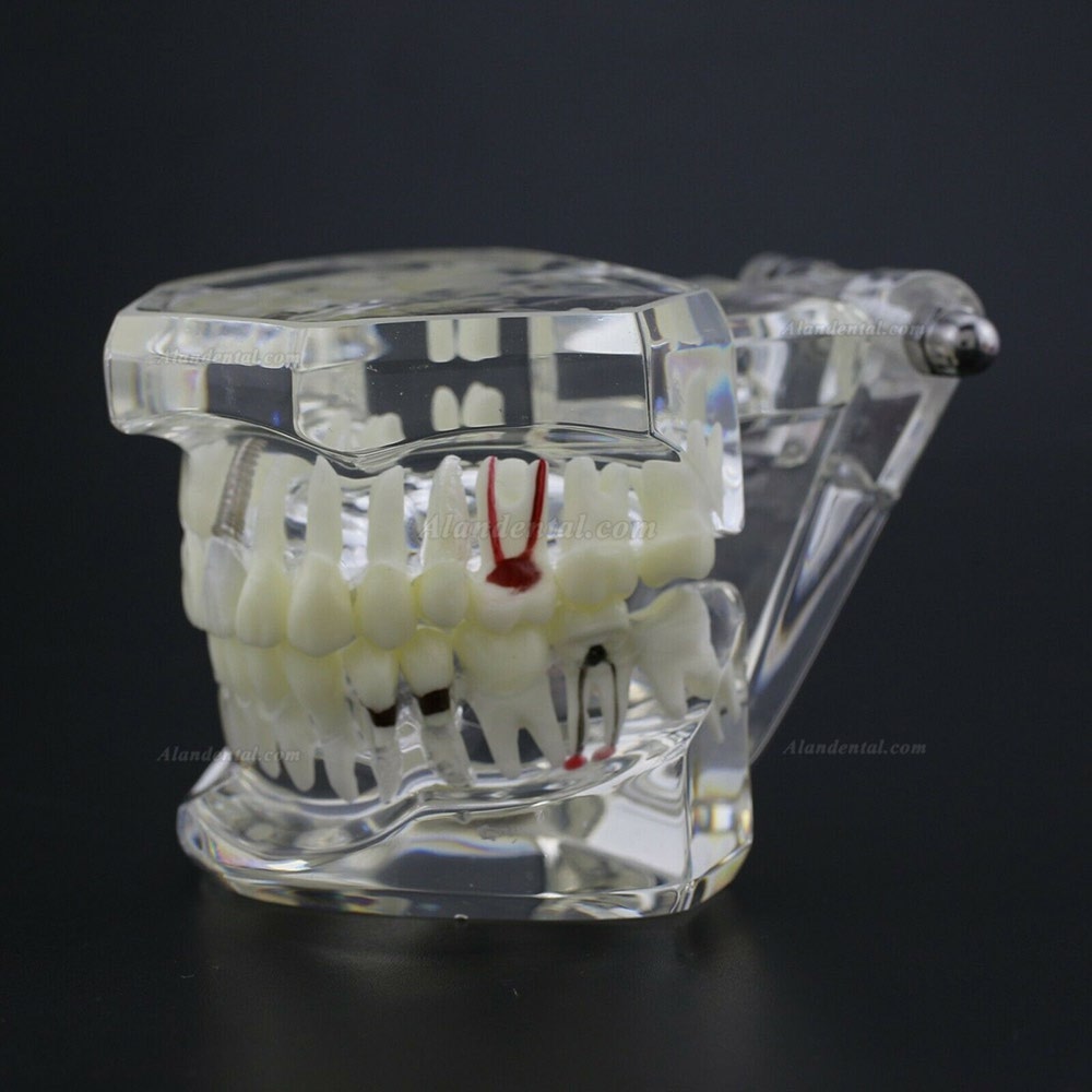 Dental Teeth Disease Model Implant Demo Caries Periodontium Transparent Pink