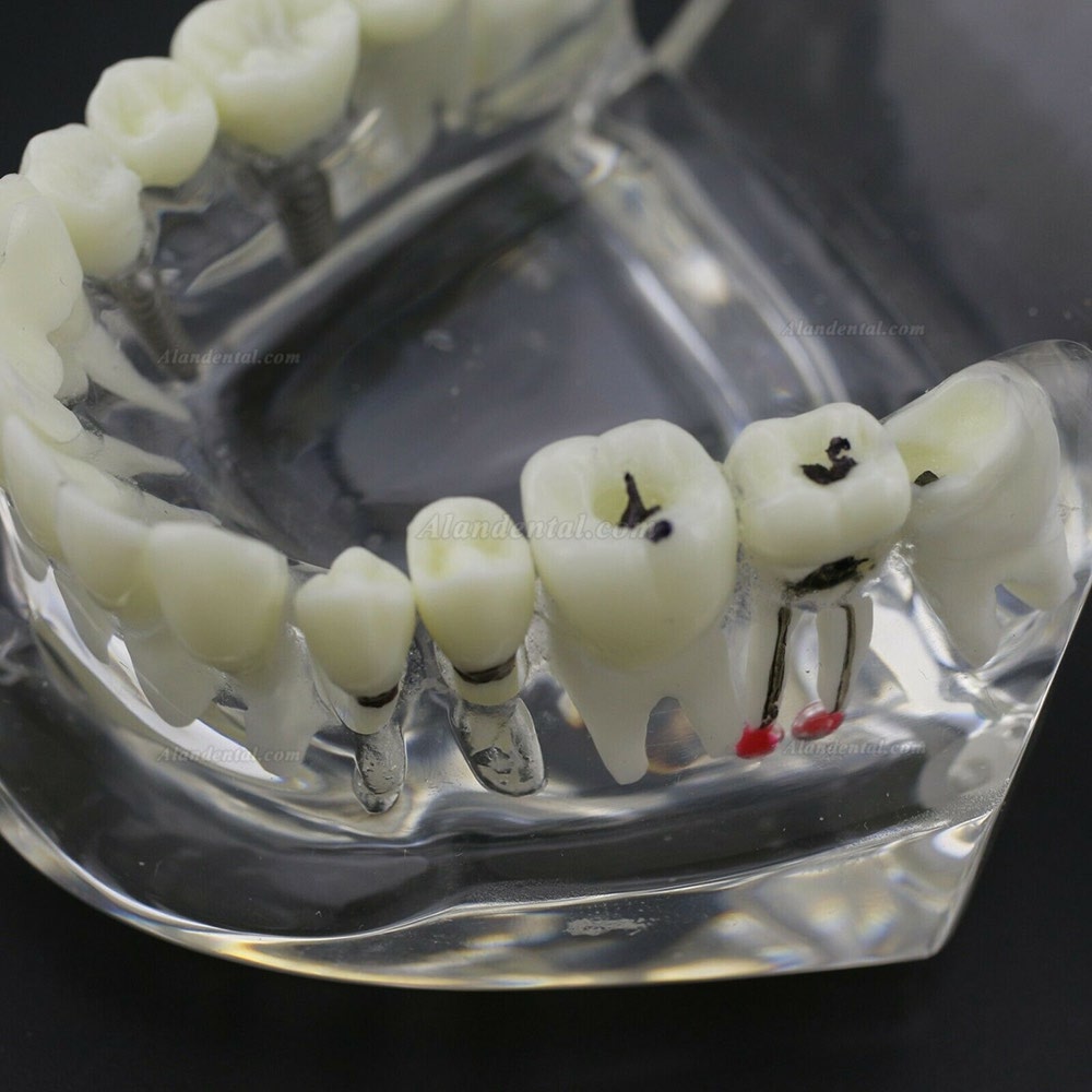 Dental Teeth Disease Model Implant Demo Caries Periodontium Transparent Pink