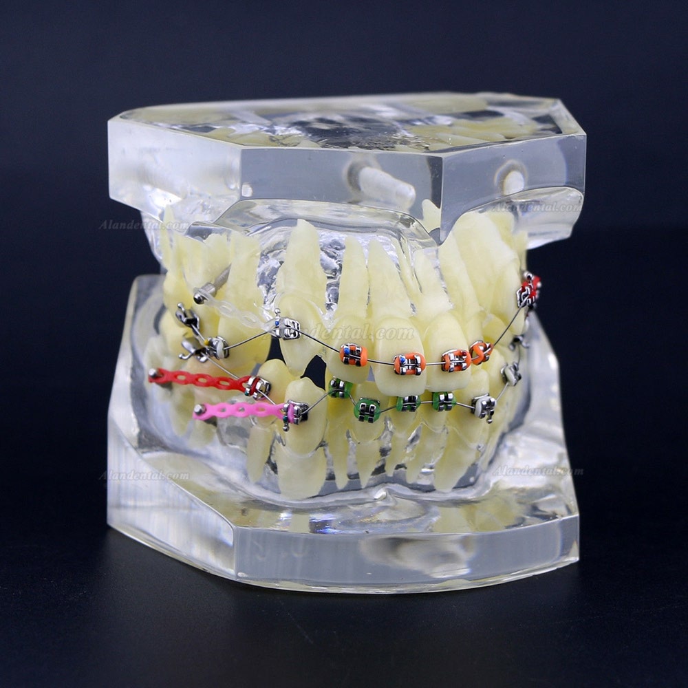 Dental Orthodontics Treatment Model With Metal Brackets Wires Ties Chain Clear