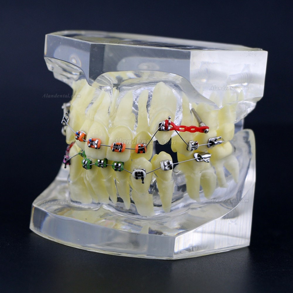 Dental Orthodontics Treatment Model With Metal Brackets Wires Ties Chain Clear