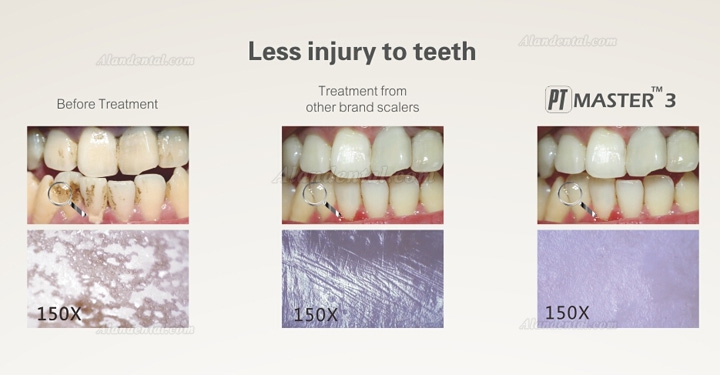 Woodpecker® PT Master 3 Dental Periodontal Treatment Device