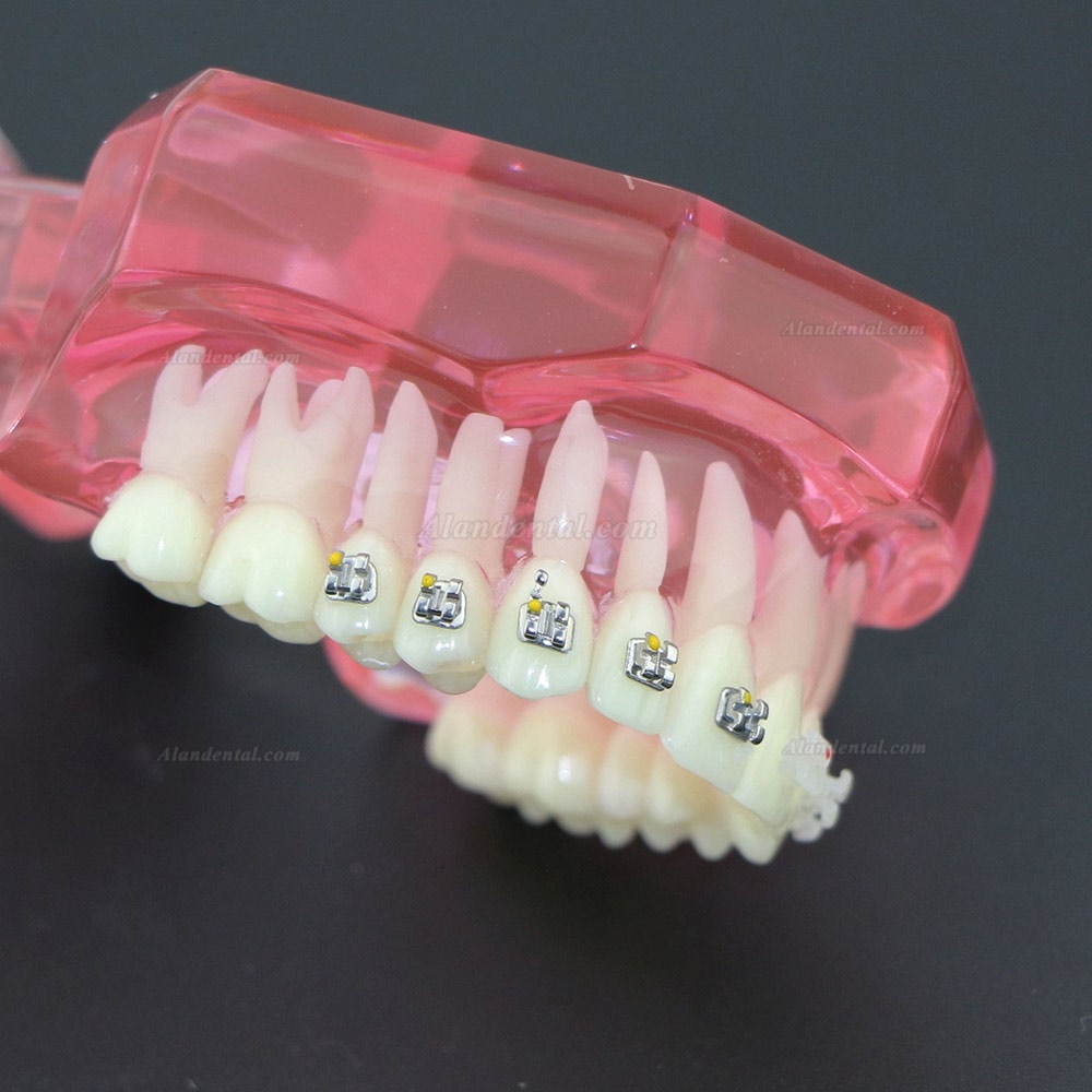 Dental Teeth Study Model Orthodontic With Metal and Ceramic Brackets 3003 Clear