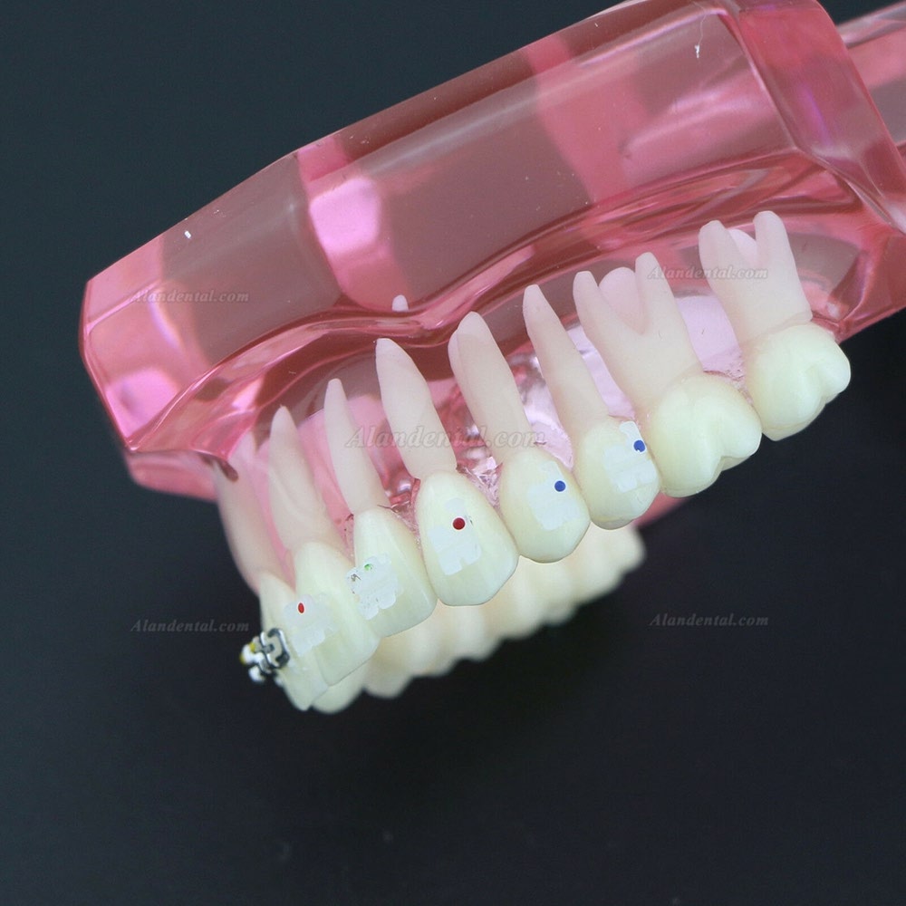 Dental Teeth Study Model Orthodontic With Metal and Ceramic Brackets 3003 Clear