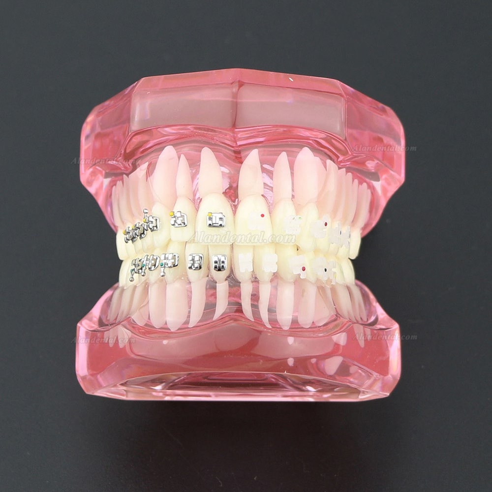 Dental Teeth Study Model Orthodontic With Metal and Ceramic Brackets 3003 Clear