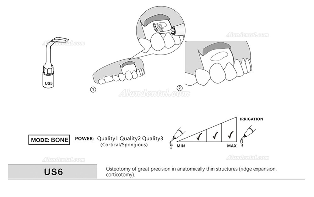 1Pcs Piezosurgery Osteotomy Bone Cutting Dental Surgery Tips US1 US1L US1R US2 US3 US4 US5 US6 US7 US11 US12 Fit Mectron