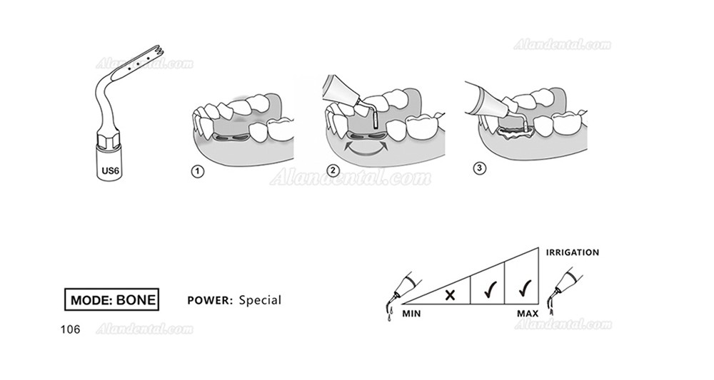 1Pcs Piezosurgery Osteotomy Bone Cutting Dental Surgery Tips US1 US1L US1R US2 US3 US4 US5 US6 US7 US11 US12 Fit Mectron