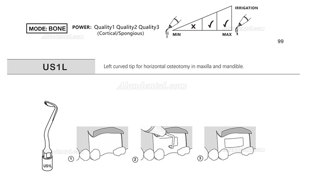 1Pcs Piezosurgery Osteotomy Bone Cutting Dental Surgery Tips US1 US1L US1R US2 US3 US4 US5 US6 US7 US11 US12 Fit Mectron