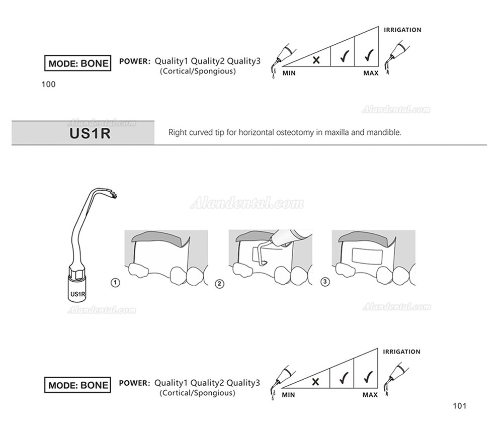 1Pcs Piezosurgery Osteotomy Bone Cutting Dental Surgery Tips US1 US1L US1R US2 US3 US4 US5 US6 US7 US11 US12 Fit Mectron